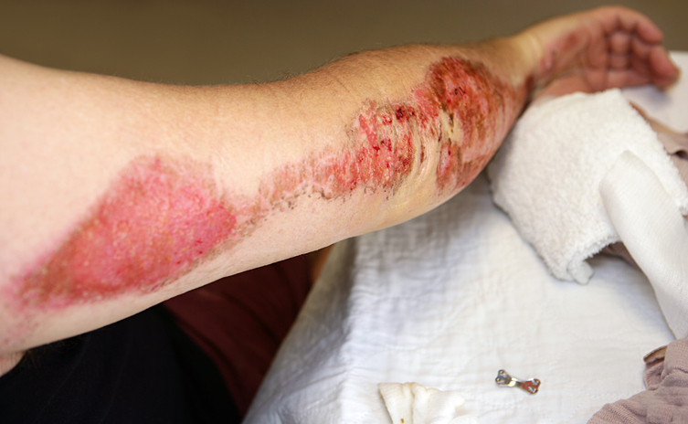 Cuts and Abrasions — Know When to Go to the ER