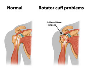 rotary cuff pain